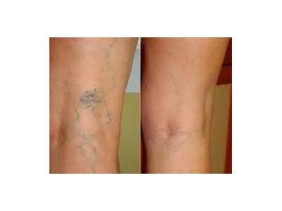 درمان هموروئید ، درمان بواسیر