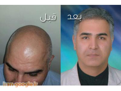 پیوند مو طبیعی-دکتر علی فولادیان مرکز کاشت موی طبیعی در تهران 