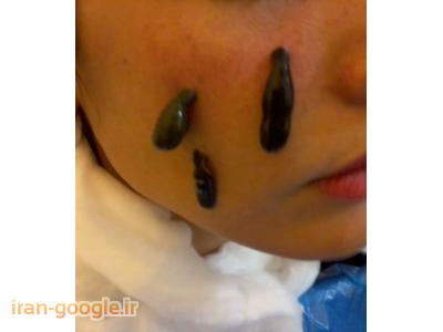 زالو درمانی در شیراز