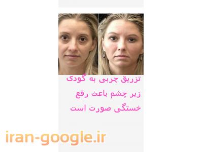 تزریق ژل در تهران-تزریق چربی صورت وبدن ودست 
