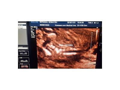 بهترین مرکز سونوگرافی در تهران nt اکوی قلب جنین