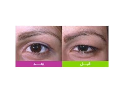 جراحی شکم و پهلو ، ماموپلاستی ، ابدومینوپلاستی و بلفاروپلاستی