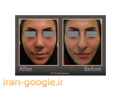 جراحی پلاستیک بینی و شکم ، پروتز سینه