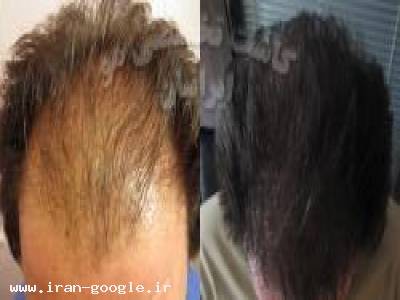 کاشت مو - پیوندطبیعی مو ایرانیان