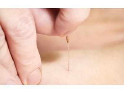 مرکز درمان نازایی و طب سوزنی در غرب تهران 