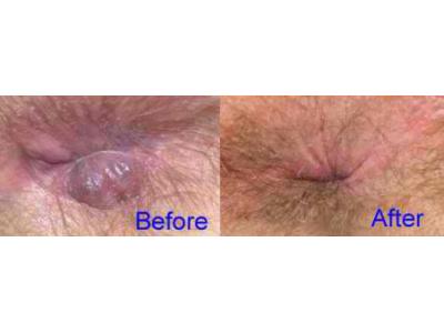 درمان قطعی هموروئید یا بواسیر با روش نوین