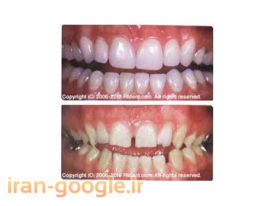 بلچینگ دندان-مرکز تخصصی دندانپزشکی