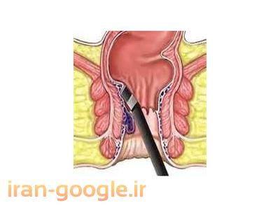 لیزر بواسیر ویژه آقایان و خانم ها - لیزر بواسیر و شقاق بدون جراحی 
