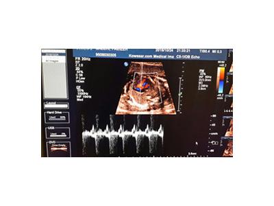 سونوگرافی تخصصی جنین-بهترین مرکز سونوگرافی در تهران nt اکوی قلب جنین