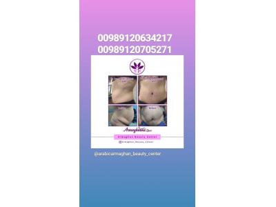 لیپوماتیک ، لیزر ، پیکرتراشی ، تزریق ژل و بوتاکس 