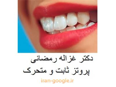 زیبایی دندان-دکتر غزاله رمضانی متخصص پروتز ثابت و متحرک ، ایمپلنت و طراحی لبخند