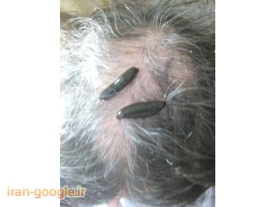 زالودرمانی و حجامت در شیراز